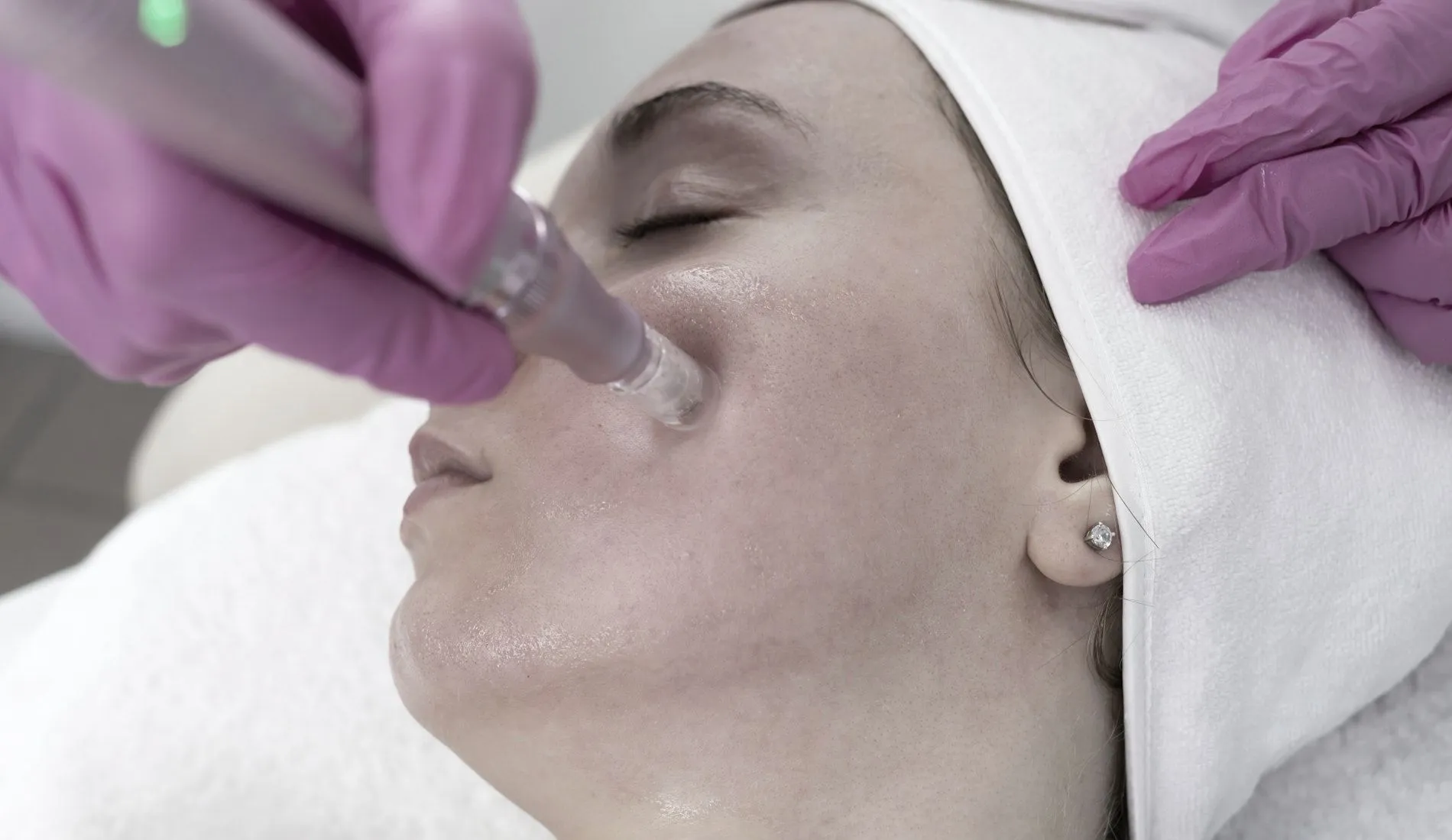 Microneedling-behandeling van het gezicht